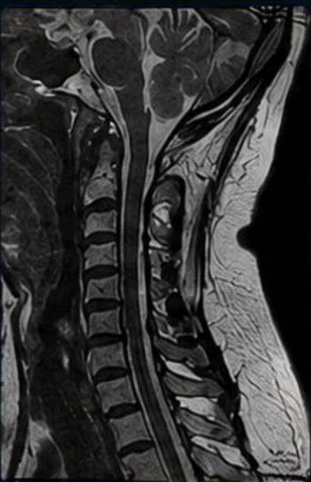 Ressonância de coluna cervical em corte sagital T2, aquisição acelerada com ruído