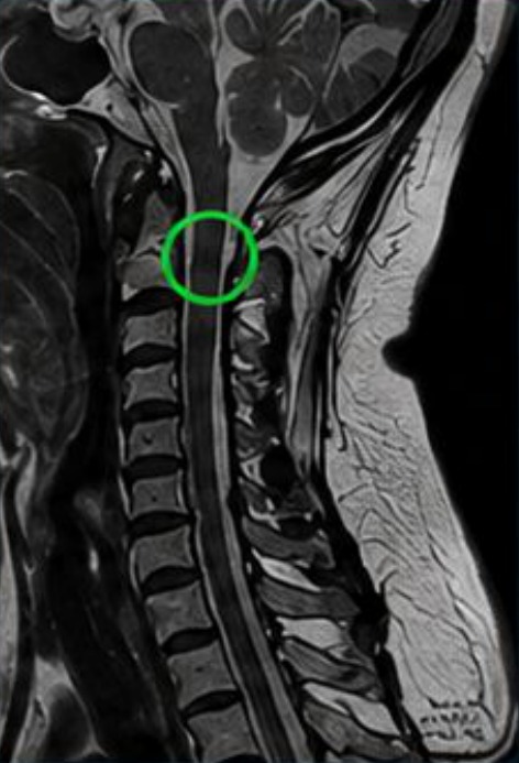 A mesma ressonância de coluna cervical após o processamento TurboMR