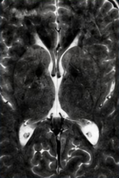 Ressonância de crânio em corte axial T2, aquisição acelerada com ruído